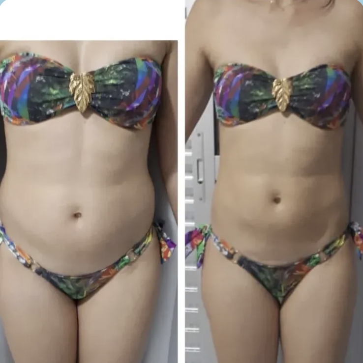 Antes e depois — Desinchamento abdominal em 30 dias